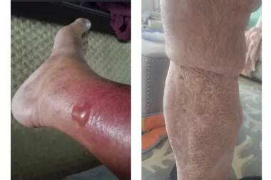Vibrio vulnificus: la amenaza silenciosa de las aguas costeras que podría costarte la vida